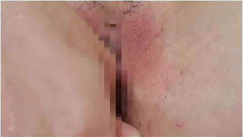 Hair Loss On Female Genitals　脱毛動画　iラインの毛を抜いてツルツルにします